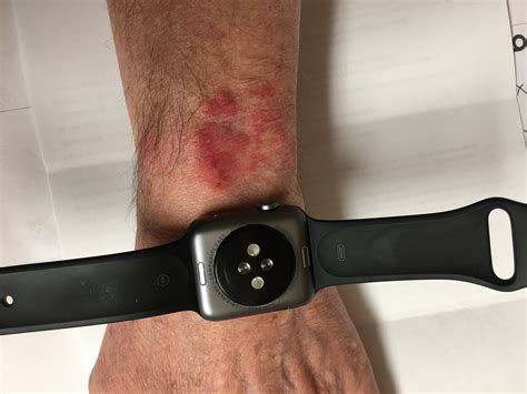 apple watch rash removal.